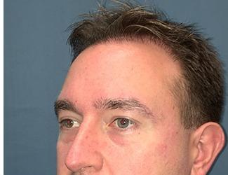NeoGraft Before & After Patient #8827