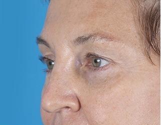 Blepharoplasty Before & After Patient #8480