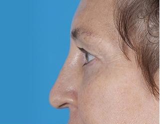 Facial Fat Grafting Before & After Patient #8742