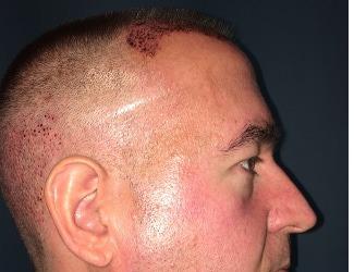 NeoGraft Before & After Patient #8827