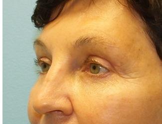 Blepharoplasty Before & After Patient #8480