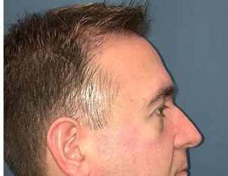 NeoGraft Before & After Patient #8827