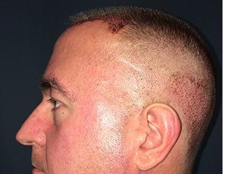 NeoGraft Before & After Patient #8827
