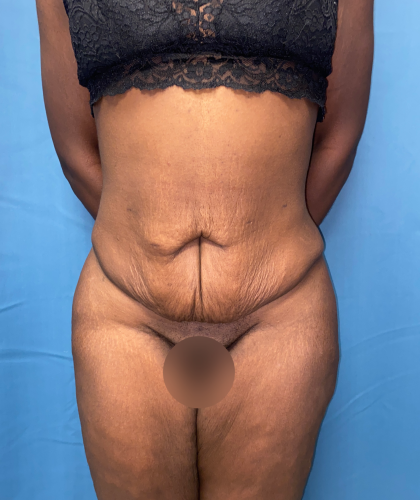Tummy Tuck Before & After Patient #8204