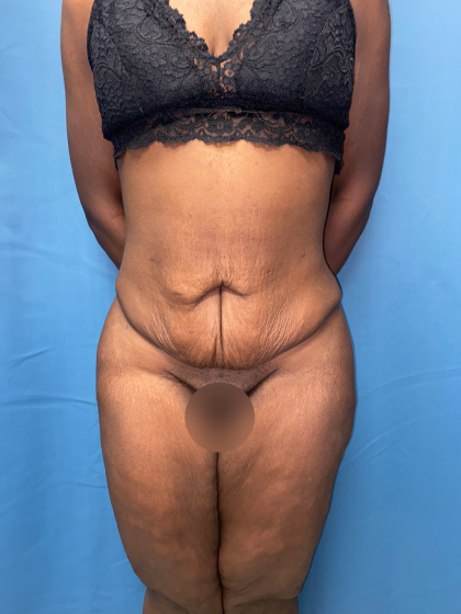 Lower Body Lift Before & After Patient #8029