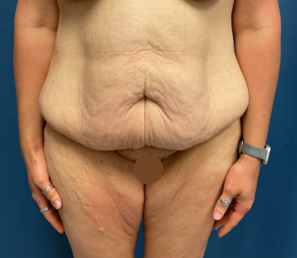 Lower Body Lift Before & After Patient #8028