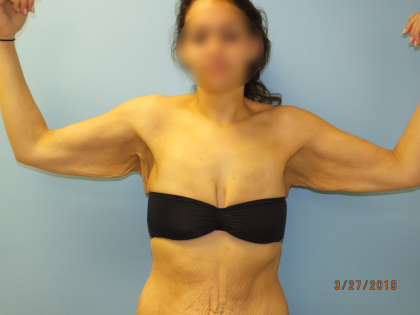 Arm Lift Before & After Patient #4821