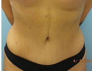 Tummy Tuck Before & After Patient #8197