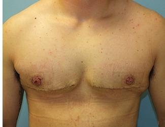 Female to Male Before & After Patient #8444