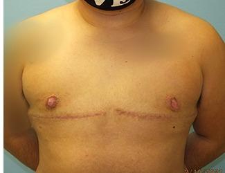 Female to Male Before & After Patient #8438