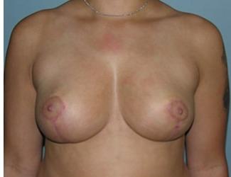 Breast Lift/Mastopexy Before & After Patient #8369