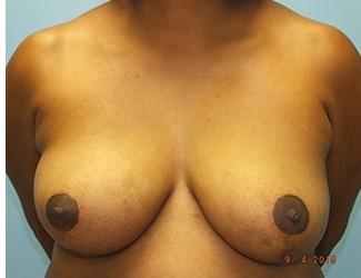 Breast Reduction Before & After Patient #8415