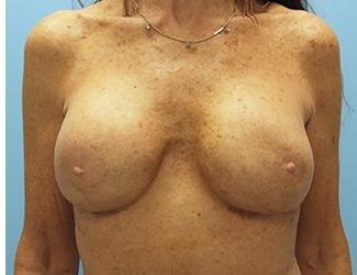 Breast Revision Before & After Patient #8240