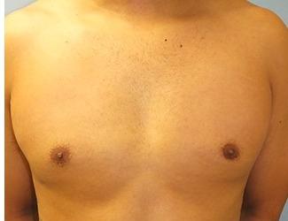 Gynecomastia Before & After Patient #8441