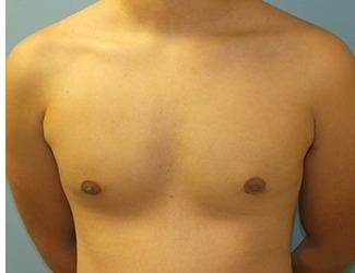 Gynecomastia Before & After Patient #8439