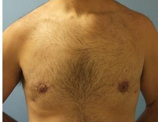 Gynecomastia Before & After Patient #8435