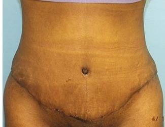 Tummy Tuck Before & After Patient #8195