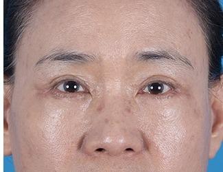 Browlift Before & After Patient #8460