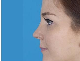 Rhinoplasty Before & After Patient #8809