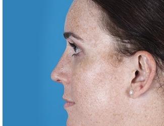 Rhinoplasty Before & After Patient #8808