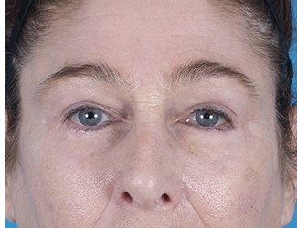 Blepharoplasty Before & After Patient #8533