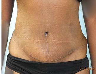 Tummy Tuck Before & After Patient #8192