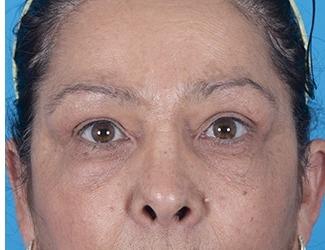 Blepharoplasty Before & After Patient #8484