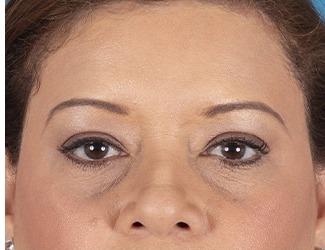 Blepharoplasty Before & After Patient #8481