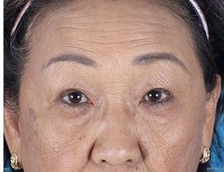 Blepharoplasty Before & After Patient #8478