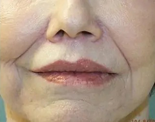 Lip Lift Before & After Patient #8800