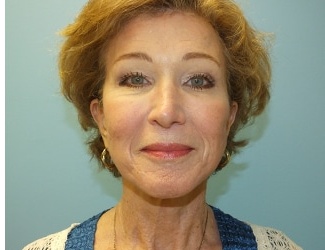 Facial Fat Grafting Before & After Patient #8745