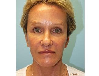 Facial Fat Grafting Before & After Patient #8741