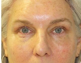 Facial Fat Grafting Before & After Patient #8744