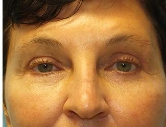 Facial Fat Grafting Before & After Patient #8742