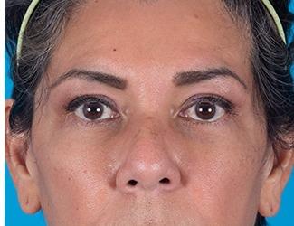 Facial Fat Grafting Before & After Patient #8743