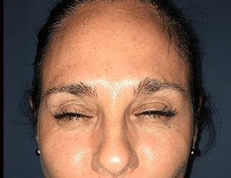 Botox Before & After Patient #8822