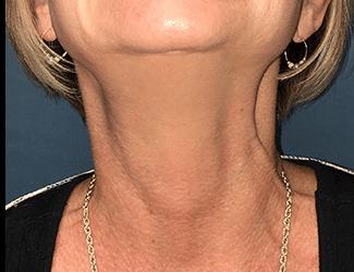 Botox Before & After Patient #8820