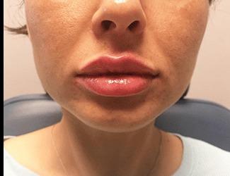Jeuvederm Before & After Patient #8824