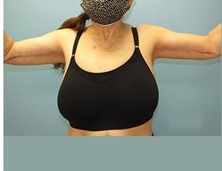 Arm Lift Before & After Patient #4690