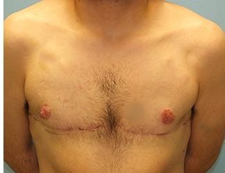 Female to Male Before & After Patient #8442