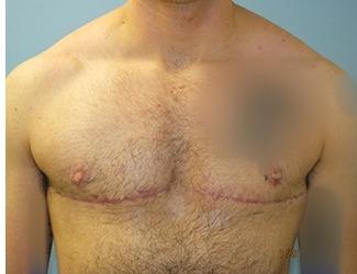 Female to Male Before & After Patient #8440