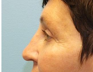 Blepharoplasty Before & After Patient #8480
