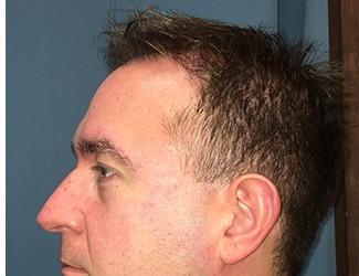 NeoGraft Before & After Patient #8827