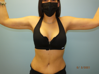Arm Lift Before & After Patient #4821