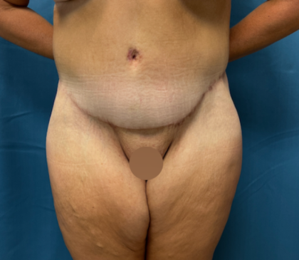 Lower Body Lift Before & After Patient #8028