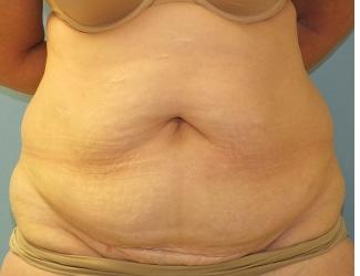 Tummy Tuck Before & After Patient #8191