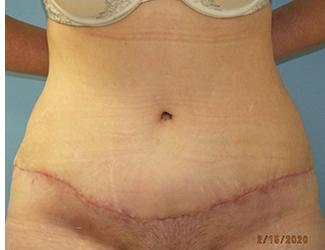 Tummy Tuck Before & After Patient #8191
