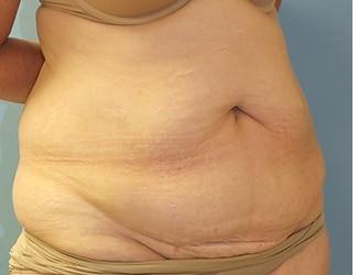 Tummy Tuck Before & After Patient #8191
