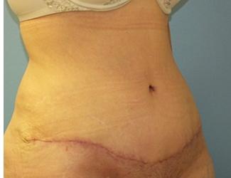 Tummy Tuck Before & After Patient #8191
