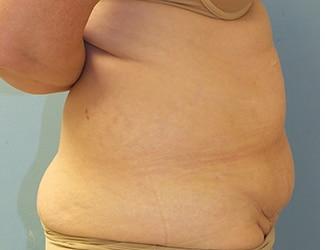 Tummy Tuck Before & After Patient #8191